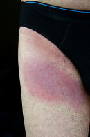 Lyme Disease caused by tick bite. Dartmoor, England